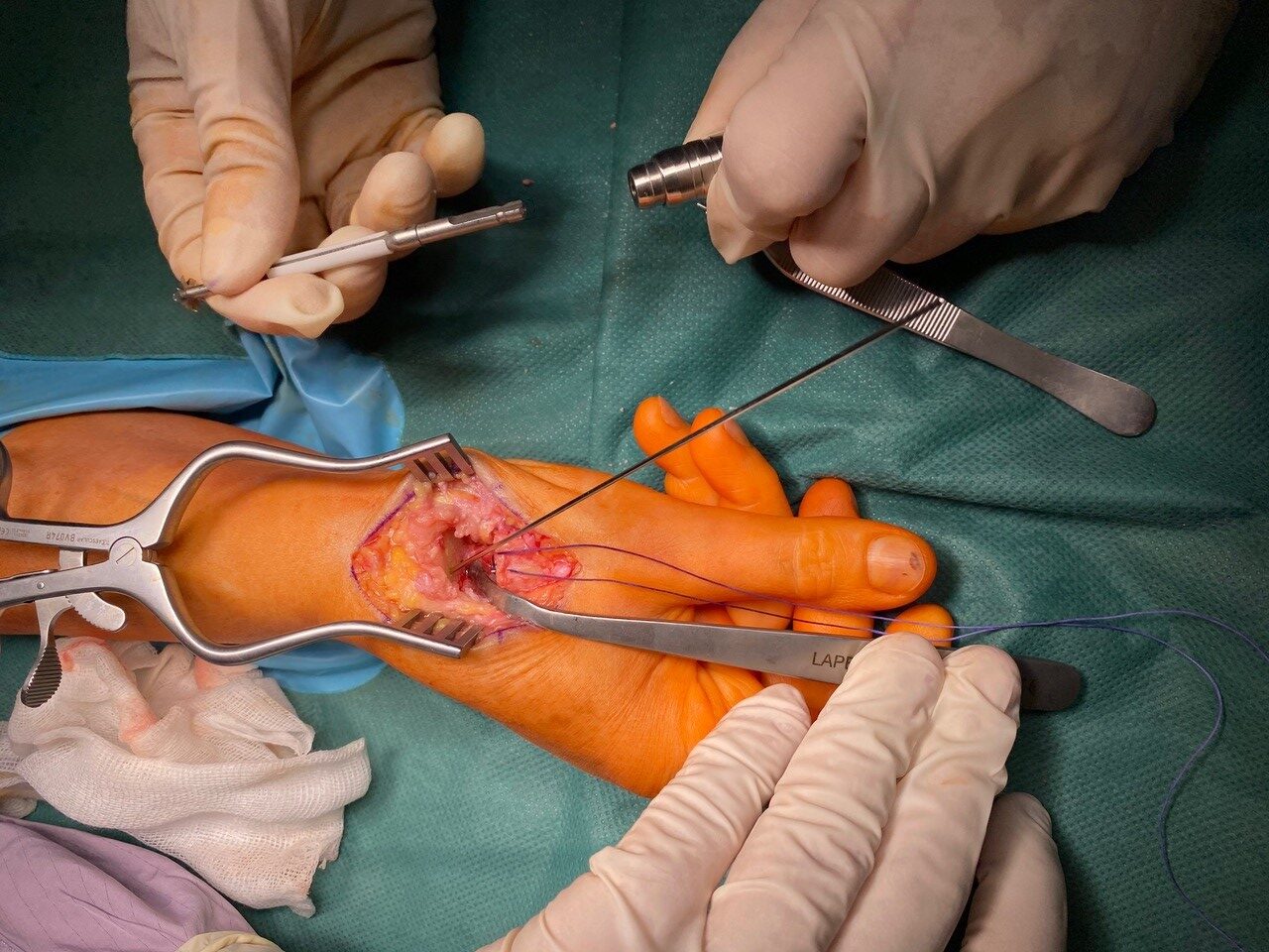 Ręka w trakcie zabiegu alloplastyki stawu podstawnego kciuka
