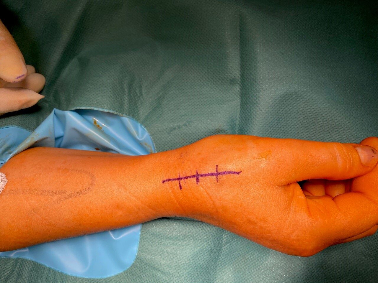 Ręka przygotowana do zabiegu alloplastyki stawu podstawnego kciuka