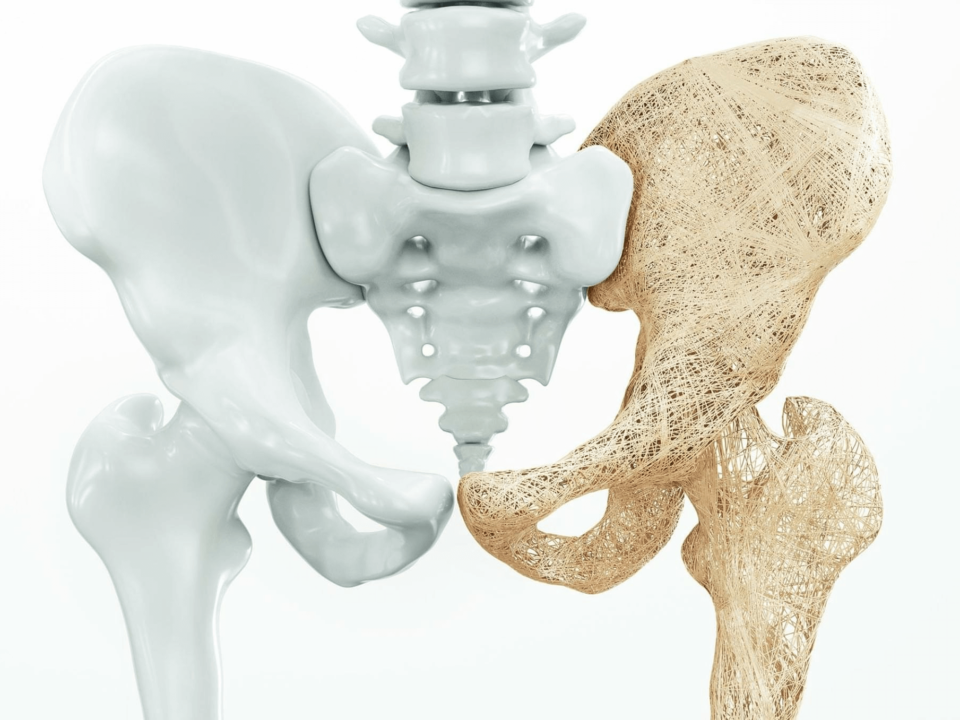Kości zdrowe i zaatakowane przez osteoporozę